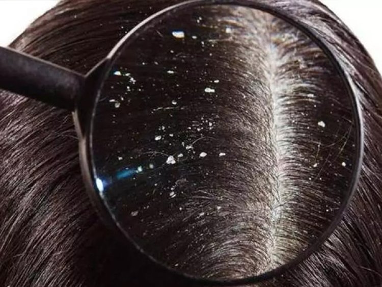 Hair Care : చుండ్రు సమస్యను శాశ్వతంగా నయం చేసే చిట్కాలు..!